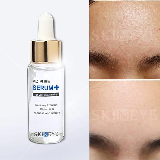 Acne & Breakouts