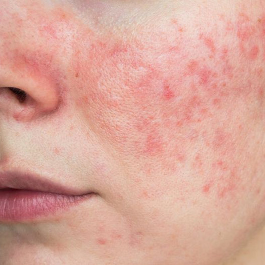 Sensitive & Reactive Skin