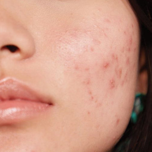 Skin Ceuticals antioxidant serum for oily, acne‐prone skin.