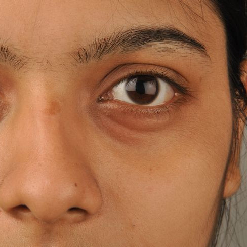 Dark Circles & Puffy Eyes